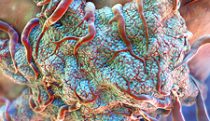 Malignant tumor