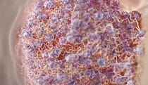 Thrombus