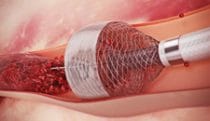 Clot removal