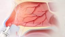 Nasal spray for cancer pain MOA