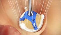 Bioprosthesis assembly & design