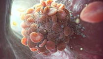 Thrombosis