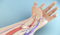 Treatment for arteriovenous fistulas