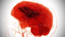 Hemorrhagic & ischemic stroke