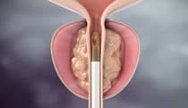 Water vapor treatment for BPH