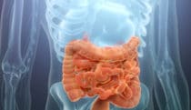 Carcinoid syndrome MOA
