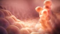 Bladder cancer