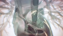 Atrial fibrillation