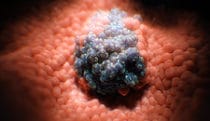 Lung cancer tumor growth