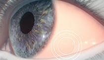 Chronic dry eye