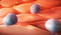 Early-stage atherosclerosis
