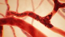 Sickle cell vaso-occlusion