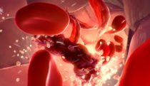 Hemolysis in sickle cell disease
