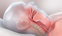 Obstructive sleep apnea