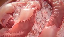 Diabetic nephropathy and CKD