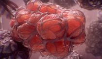 Pneumonia infection