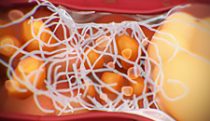 Nonalcoholic steatohepatitis (NASH)
