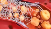 Hepatic lipotoxicity & NASH