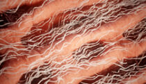 Light chain (AL) amyloidosis