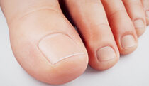 Onychomycosis / nail fungal disease